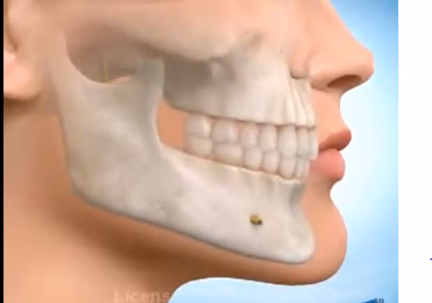 Trước khi tiến hành phẫu thuật, các chị em sẽ được các bác sĩ tư vấn tận tình và kiểm tra sức khỏe để xem liệu với tình trạng cơ địa của bạn có đủ để thực hiện cuộc phẫu thuật hay không. Tiếp đó, các bác sĩ sẽ chụp X-Quang hàm mặt để xác định tổng quát hình dáng xương hàm của bạn, sau đó xác định những vị trí cần cắt, gọt. Khoảng 6h trước khi tiến hành phẫu thuật, bạn cần phải nhịn ăn, vệ sinh răng miệng và xúc miệng bằng nước sát khuẩn.