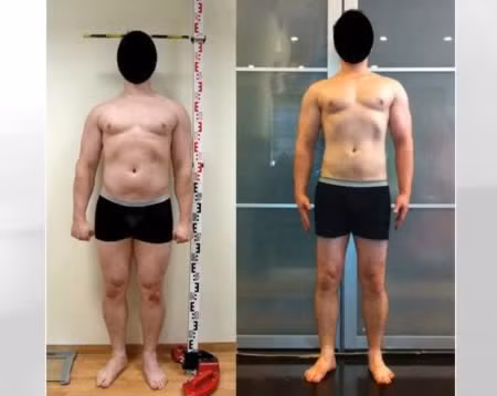Không chỉ những cô gái mới tiến hành phẫu thuật kéo dài xương chân để có đôi chân dài như ý mà nhiều chàng trai cũng có thể thực hiện phương pháp này để cải thiện chiều cao.