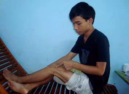 Bệnh nhân Đinh Trọng Hiếu chỉ vị trí mũi khoan bị bỏ quên trong chân em.