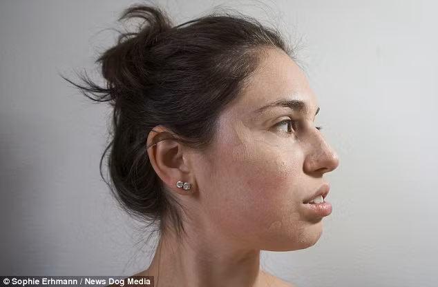 “Tôi muốn có nhiều người nhận thức được dermatillomania ảnh hưởng như nào tới cuộc sống. Hi vọng qua những hình ảnh của tôi, mọi người sẽ nhận biết triệu chứng cơ thể rối loạn, kịp thời khám bác sĩ để có chẩn đoán sớm nhất”, Sophie chia sẻ.