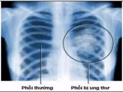 Một nửa trong số họ có 3 lần chụp CT liều thấp hàng năm - một loại tia X nhạy hơn bình thường - và một nửa có ba lần chụp X-quang. 1.089 bệnh ung thư phổi được chẩn đoán ở bệnh nhân chụp CT, so với 969 đối với những người đã chụp X-quang.