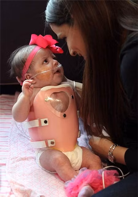 Bé Audrina mắc phải căn bệnh lạc vị tim ổ bụng, một trường hợp hiếm gặp khiến tim trẻ sơ sinh nằm ngoài lồng ngực.
