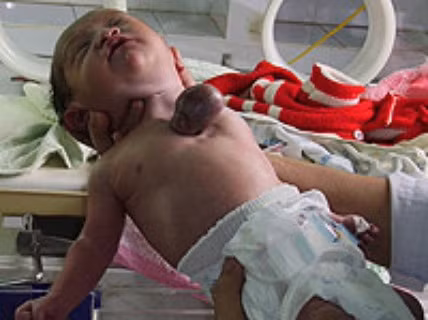 Không chỉ ở nước ngoài, trường hợp bé sơ sinh có trái tim ngoài lồng ngực cũng từng xuất hiện tại Việt Nam, hồi tháng 3/2007, bệnh viện Đa khoa Quảng Ngãi đã thực hiện ca mổ đẻ cho chị Lê Thị Đào (SN 1974, huyện Tư Nghĩa, Quảng Ngãi). Khi lấy đứa trẻ ra khỏi bụng mẹ, các bác sĩ phát hiện cháu bé có trái tim nằm ngoài lồng ngực. Trừ trái tim nằm ngoài lồng ngực, các bộ phận còn lại của cháu đều bình thường.