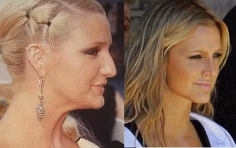 Ashlee Simpson. Nằm trong số những điển hình về phẫu thuật thẩm mỹ thành công, Ashlee Simpson chỉnh sửa chiếc mũi to của mình cho thon nhỏ hơn, thẳng hơn vào năm 2006. Điều này càng tôn thêm vẻ đẹp sẵn có của cô.