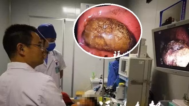 An 1 loai qua khi doi, nguoi phu nu bi soi to nhu trung ngong