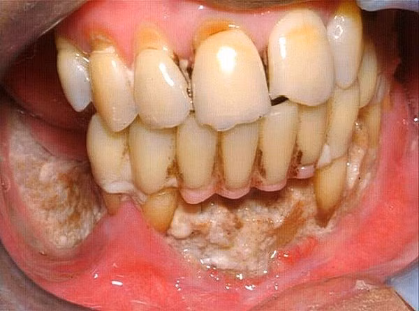 Độc tính trong Krokodil không chỉ dừng lại ở sức tàn phá của desomorphine. Phốt pho có trong hỗn hợp thuốc nếu lẫn phốt pho trắng có thể gây ra hoại tử xương hàm hay còn gọi là bệnh “hàm Phossy”. Nếu không phẫu thuật cắt bỏ xương hàm sớm, bệnh nhân sẽ bị tổn thương não, rồi từ từ chết rất đau đớn vì hoại tử.