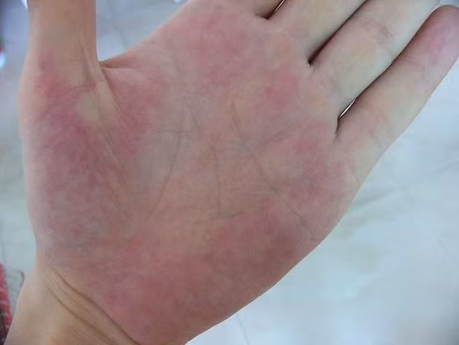 Tiền ung thư gan xuất hiện dấu hiệu này cần đi gặp bác sĩ ngay - Hình 4 Tien ung thu gan xuat hien dau hieu nay can di gap bac si ngay-Hinh-4