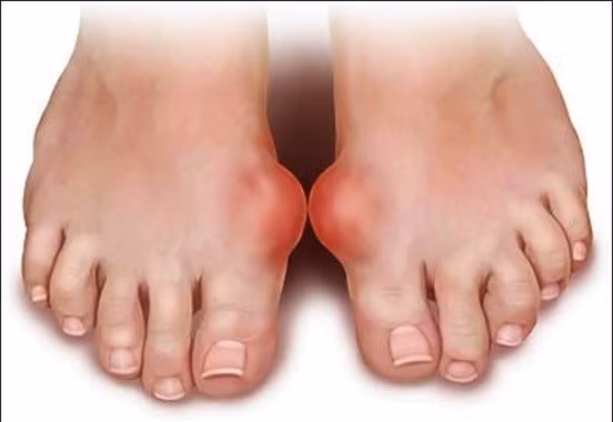 Dấu hiệu nhỏ trên bàn chân cảnh báo "trọng bệnh" ảnh 2 Dấu hiệu nhỏ trên bàn chân cảnh báo "trọng bệnh" ảnh 2