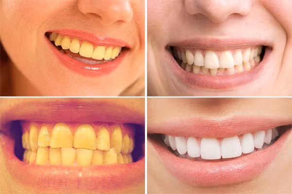 Làm trắng răng: Làm ướt bàn chải của bạn và nhúng vào hỗn hợp bột nghệ nguyên chất. Chải răng với các thao tác như bình thường và để hỗn hợp này trên răng từ 3-5 phút. Xúc miệng lại với nước sau đó chải lại răng với kem đánh răng. Công thức này sẽ khiến hàm răng của bạn trắng lên trông thấy.
