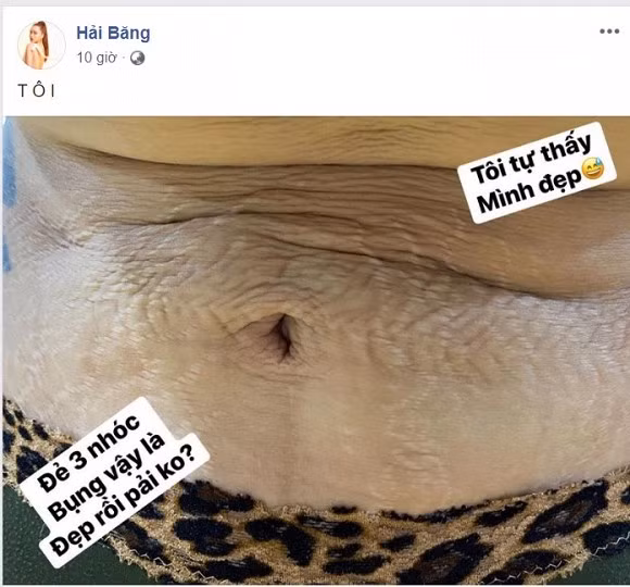 Hải Băng hé lộ hình ảnh bụng chằng chịt vết rạn sau 3 lần sinh Hai Bang he lo hinh anh bung chang chit vet ran sau 3 lan sinh