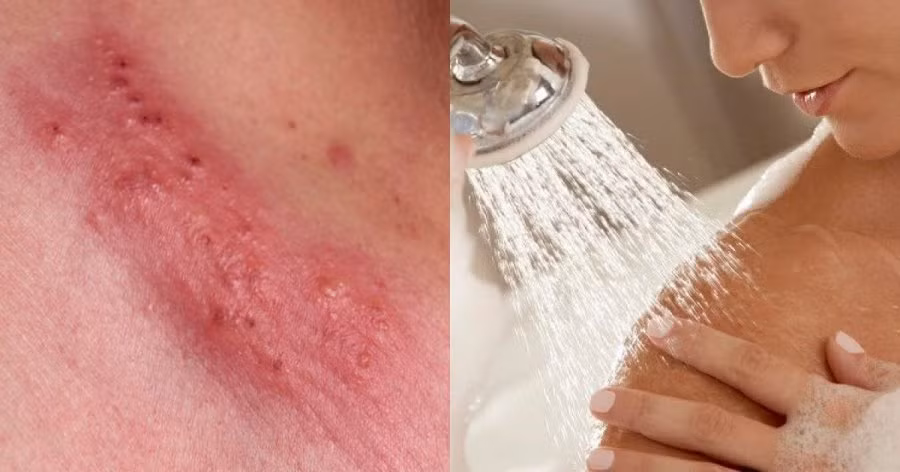 3 mẹ con nhiễm HPV, nguyên nhân vì vật thường dùng trong nhà tắm 3 me con nhiem HPV, nguyen nhan vi vat thuong dung trong nha tam