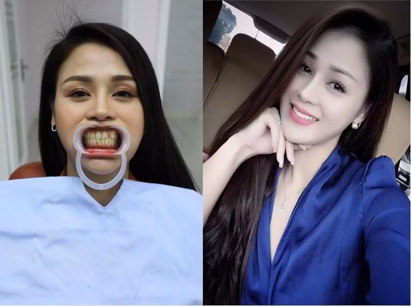 Thu Trang lột xác sau khi nâng mũi và sửa răng.