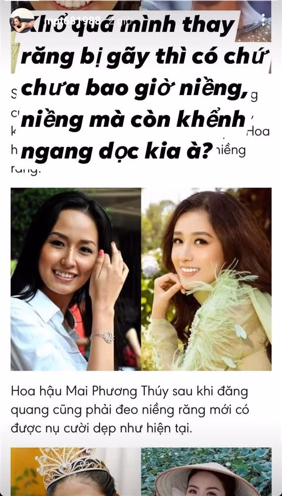Người đẹp đồng thời chỉ ra những chiếc răng khểnh của mình, chứng minh tin đồn hoàn toàn sai sự thật. "Khổ quá, mình thay răng bị gãy thì có, chứ chưa bao giờ niềng răng. Niềng mà còn khểnh ngang dọc kia à?", chân dài bày tỏ.