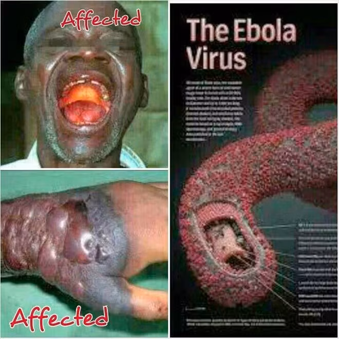 Hình ảnh bệnh sốt xuất huyết do virus Ebola gây nên.