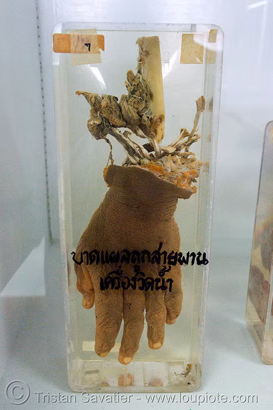 Bàn tay bị xé rời khỏi cánh tay.