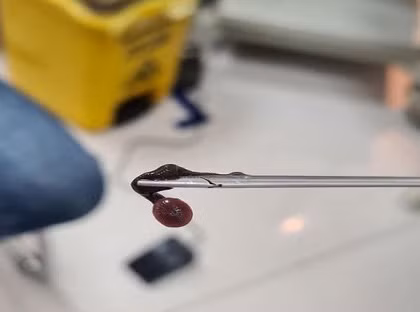 Kinh hoàng gắp con đỉa dài 3cm ký sinh trong hốc mũi người phụ nữ Kinh hoang gap con dia dai 3cm ky sinh trong hoc mui nguoi phu nu