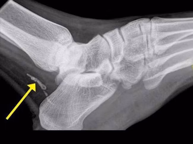 Người đàn ông này chụp X-quang mới biết chân mình bị nhiễm giun. Nếu không nhanh chóng loại bỏ, con giun này có thể phát triển tới gần 1m trong cơ thể người.