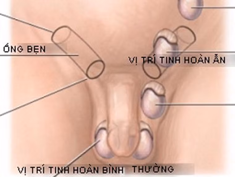 Người có tinh hoàn ẩn. Tinh hoàn ẩn là sự bất thường khi tinh hoàn không nằm trong bìu mà dừng lại trên đường di chuyển ở thời kỳ phôi thai. Tinh hoàn ẩn thường gặp ở các lứa tuổi sơ sinh (3-5%), 3 tuổi (0,8%) và khá hiếm gặp khi đã trưởng thành (tỷ lệ nam giới trên 18 tuổi có tinh hoàn ẩn chỉ còn 0,25-0,1%). Người có tinh hoàn ẩn đối diện với nguy cơ mắc ung thư khá cao (2,5 – 14%). May mắn thay, mối nguy này có thể được ngăn ngừa bằng cách phẫu thuật trước khi bé trai đến tuổi dậy thì.