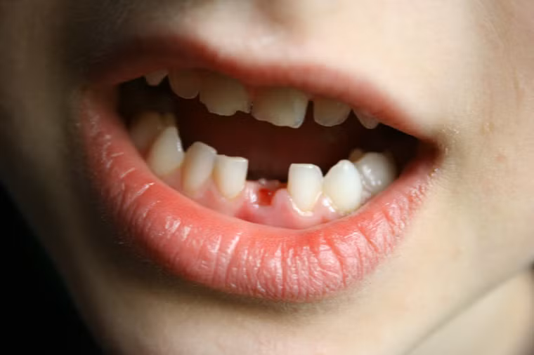 Các vấn đề về da, răng và móng tay. Theo eMedicine, người mắc ung thư tủy có thể gặp các vấn đề về sức khỏe như sâu răng, gãy răng, móng tay bị biến dạng, bật móng, lở loét vùng miệng.
