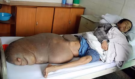 Chen Zongtao, 29 tuổi, sống trong một ngôi làng hẻo lánh của Trung Quốc và không đủ tiền chi trả phí y tế nên đã để mặc cho khối u phát triển tới kích cỡ cực khủng và trọng lượng 70kg.