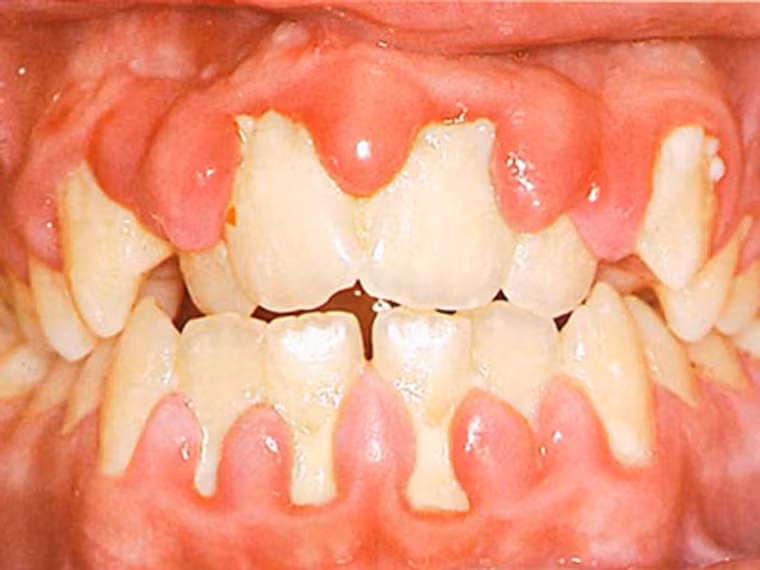 Viêm miệng. Không giống các vấn đề trên, viêm miệng chủ yếu tấn công người sử dụng răng giả không đảm bảo vệ sinh sạch sẽ. Theo thời gian, các mảng bám thức ăn tạo môi trường lý tưởng cho nấm candida albicans tích tụ, gây tình trạng viêm khó chịu.