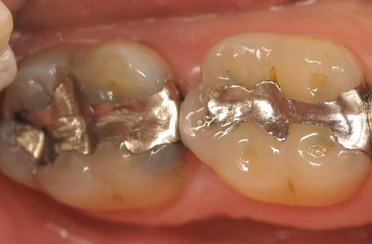 Sâu răng. Ở người lớn tuổi, sâu răng thường đi kèm với tụt nướu do tác động của vi khuẩn lên thực phẩm, tạo ra axit phá hủy cấu trúc răng. Để ngăn ngừa, nên súc miệng sau mỗi lần ăn. Bên cạnh đó, bạn cũng nên giảm lượng tiêu thụ đường và duy trì đánh răng hai lần mỗi ngày.