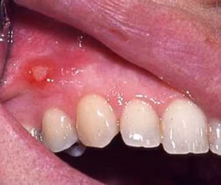  Ung thư miệng. Đây được xem là vấn đề nghiêm trọng nhất đối với sức khỏe răng miệng. Đặc biệt, khoảng 50% trường hợp mắc bệnh được phát hiện khi tế bào ung thư đã di căn nên tỷ lệ sống sót là khá thấp. Chính vì vậy, để bảo vệ mình ngoài việc vệ sinh răng miệng thường xuyên, bạn cần tránh lạm dụng thuốc lá, ăn trầu và nghiện rượu.