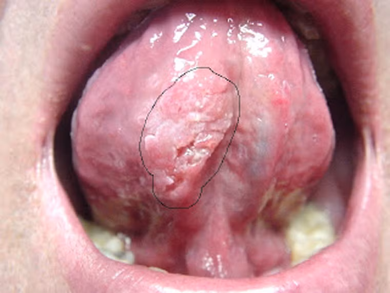 Đôi khi, khối u không mang lại cảm giác đau đớn khiến bệnh nhân khó nhận biết được dấu hiệu bất thường cho tới khi chúng to dần, di căn. Điều này khiến bệnh nhân dễ dàng đối diện tình trạng suy dinh dưỡng.