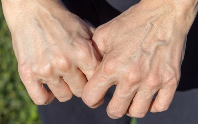 Bàn tay nổi gân xanh kéo dài: Nếu một ngày nào đó bàn tay nổi gân xanh đột ngột, những đường gân này nổi lên rõ ràng và kéo dài khoảng 3 tháng trở đi, bạn nên cẩn thận đề phòng tổn thất lớn về tiền bạc, thậm chí phải mắc khoản nợ khổng lồ. (*)Thông tin chỉ mang tính tham khảo, chiêm nghiệm