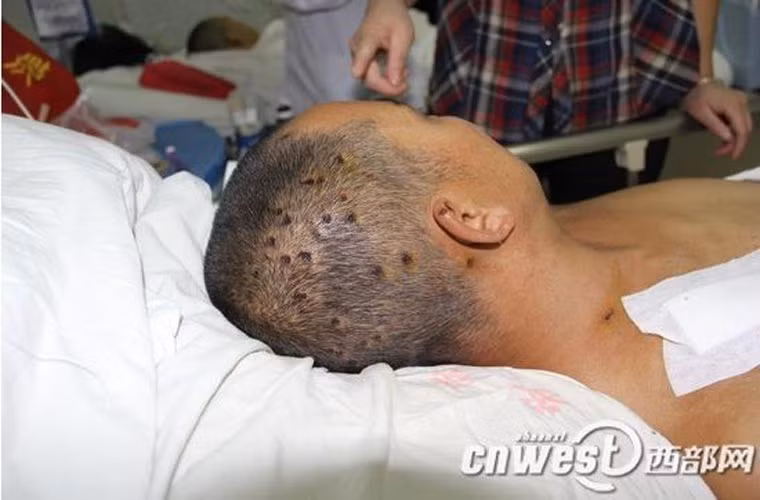 Tính tới tháng 10/2013, loài ong này đã giết chết 42 người tại Trung Quốc.