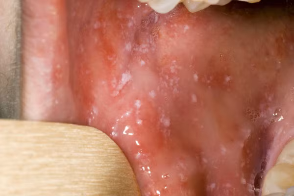Viêm miệng: Loét, lở trong miệng, có thể loét cả ngoài môi gây sốt đau, rối loạn tiêu hóa trong vài tuần thậm chí dẫn tới nhiễm trùng huyết. Đôi khi gặp cả viêm miệng hoại tử (Noma).