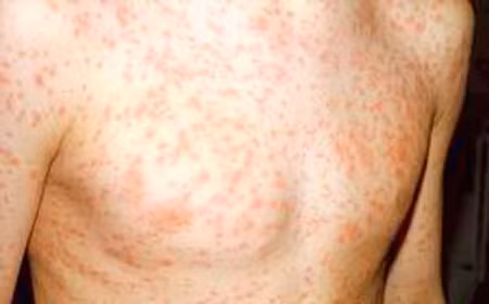 Viêm phổi: Đây là một trong những biến chứng thường gặp nhất. Viêm phổi có thể do chính virut sởi gây tổn thương mô kẽ và cũng có thể do bội nhiễm vi trùng khác. Tác nhân thường là phế cầu liên cầu tiêu huyết, tụ cầu vàng.