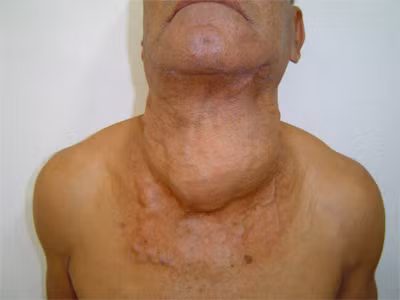 Tỷ lệ sống của bệnh nhân bị ảnh hưởng bởi loại ung thư này là rất thấp, vì các khối u chỉ được chẩn đoán ở giai đoạn sau.