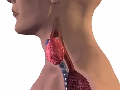 2. Ung thư nang xảy ra ở khu vực triiodothyronine trong những phụ nữ thuộc nhóm tuổi 50 trở lên. Các khối u nang có một lớp mô mỏng xung quanh, được gọi là viên nang.