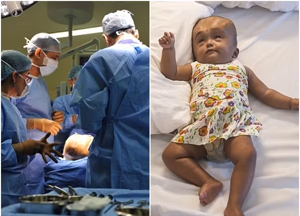 Roona Begum (3 tuổi) ở Ấn Độ bị mắc bệnh úng thủy não khiến đầu của em tăng lên gấp 3 lần bình thường. Roona Begum đã được đưa tới bệnh viện ở New Delhi, Ấn Độ, năm ngoái.
