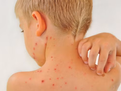 Dễ bị dị ứng. Có một điều rất dễ nhận thấy, đó chính là những trẻ em ăn nhiều đồ ngọt lại thường bị dị ứng. Các nghiên cứu mới của trường Đại học tại Hoa Kỳ đã chỉ ra rằng đồ ngọt có thể ảnh hưởng đến chức năng của bạch cầu và thay đổi thành mạch máu dẫn đến sự giảm sức đề kháng, dễ bị viêm, dị ứng và gặp các vấn đề về da.