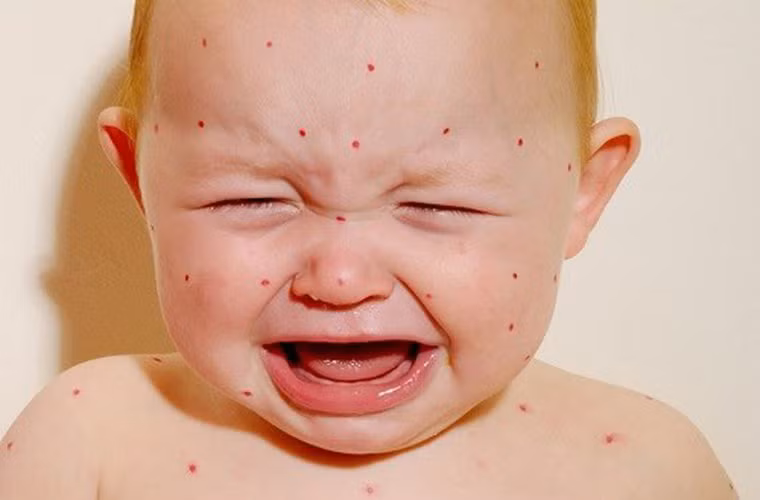 Khi bệnh toàn phát, bệnh nhân có thể sốt cao 38,5 đến 39 độ C, mệt mỏi, ban sởi dày, mịn, xuất hiện đầu tiên ở sau tai rồi lan rộng. Bệnh lui khi hết sốt, ban mất dần theo trình tự mọc và để lại vết thâm trên da.
