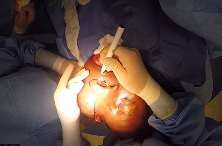 Do gia cảnh túng quẫn, Hennglise không được chữa trị cho đến khi được tổ chức từ thiện Operation Smile tài trợ chi phí phẫu thuật ngày 28 tháng 4 vừa qua.
