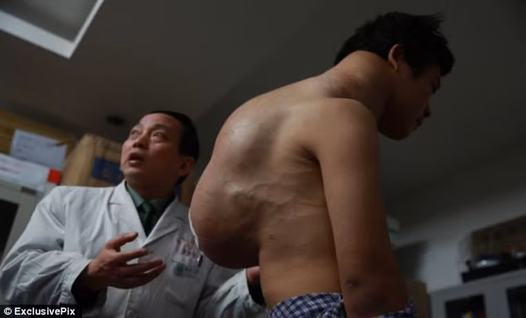 Các bác sĩ cũng cảnh báo ca phẫu thuật có thể rất khó khăn, nguy hiểm bởi khối u đã gắn chặt với cột sống, nối liền các mạch máu trong cơ thể Xiao. Thời điểm này, anh chưa đủ quyết tâm cũng như tài chính để tiến hành điều trị.