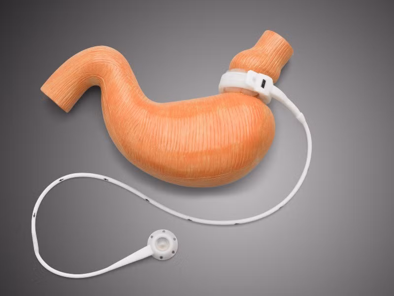 Phương pháp thắt đai dạ dày để giảm cân