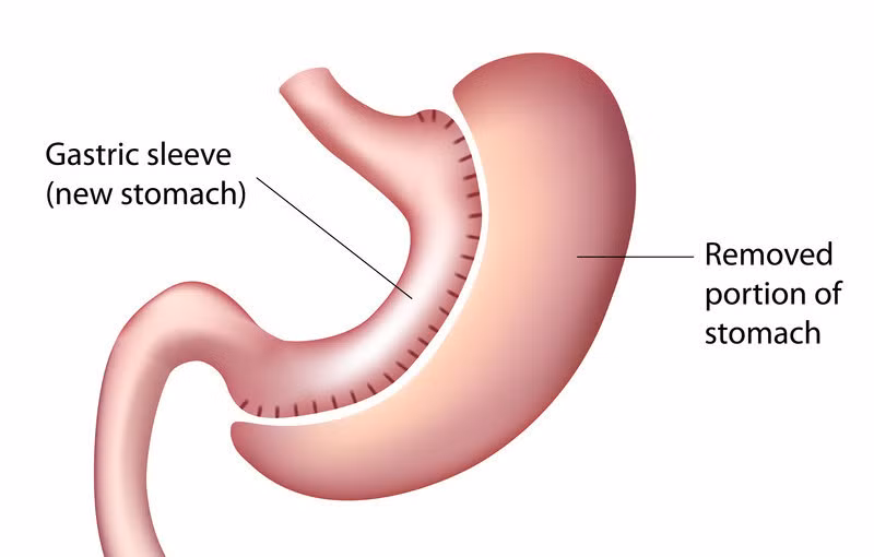 Bác sĩ sẽ cắt bỏ vùng phình vị lớn để thu nhỏ dạ dày.