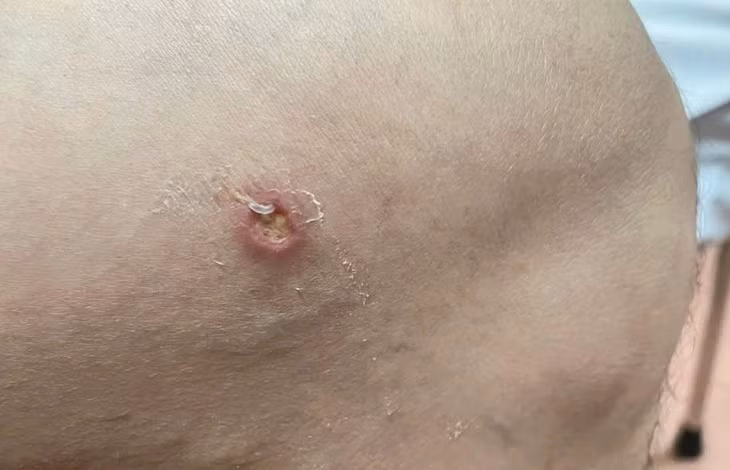 Phát hiện thêm ca bệnh giun rồng thứ 26 tại Phú Thọ Phat hien them ca benh giun rong thu 26 tai Phu Tho