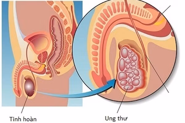 3 căn bệnh ung thư nếu phát hiện sớm có thể chữa khỏi hoàn toàn 3 can benh ung thu neu phat hien som co the chua khoi hoan toan