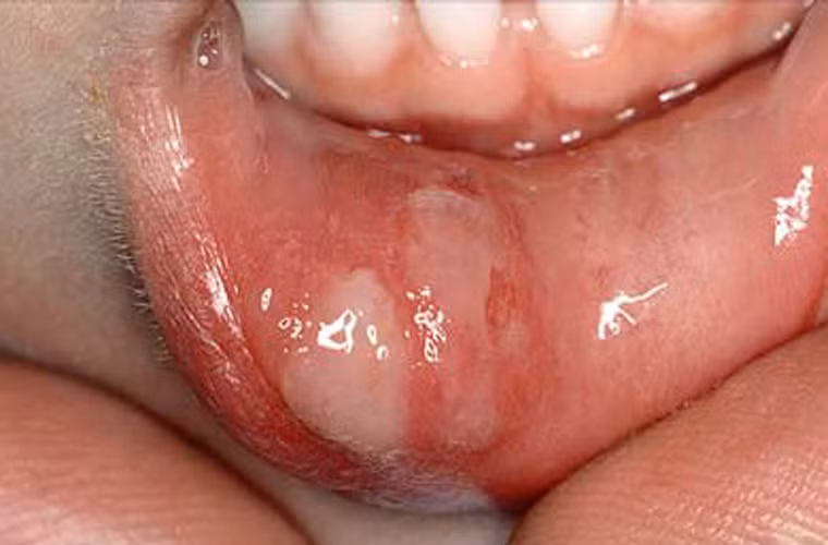 Nghiên cứu này không chỉ rõ vì sao vệ sinh răng miệng kém lại làm tăng nguy cơ nhiễm HPV. Tuy nhiên, các nhà khoa học nhấn mạnh virus HPV thường ẩn náu ở những vết thương nhỏ trong miệng hoặc cổ họng. Đặc biệt chỗ bị viêm loét, viêm nướu sẽ giúp HPV nhanh chóng di chuyển vào máu.