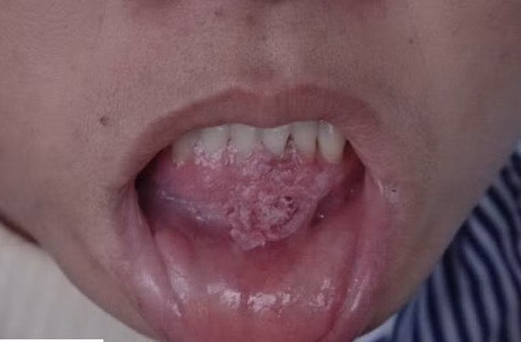 Cụ thể, những người vệ sinh răng miệng kém, có các biểu hiện như nướu răng, hỏng răng sẽ dễ dàng nhiễm virus gây u nhú HPV hơn cả.