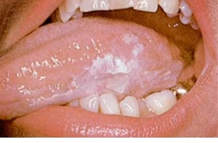 Ở Mỹ, nghiên cứu chỉ ra khoảng 7% người trưởng thành bị nhiễm HPV ở miệng. Loại virus này cũng được chứng minh là nguyên nhân gây ra 40 – 80% các trường hợp ung thư vùng hầu họng. Có nhiều chủng HPV nhưng một số chủng có khả năng gây ung thư, u nhú hoặc mụn cóc ở miệng.