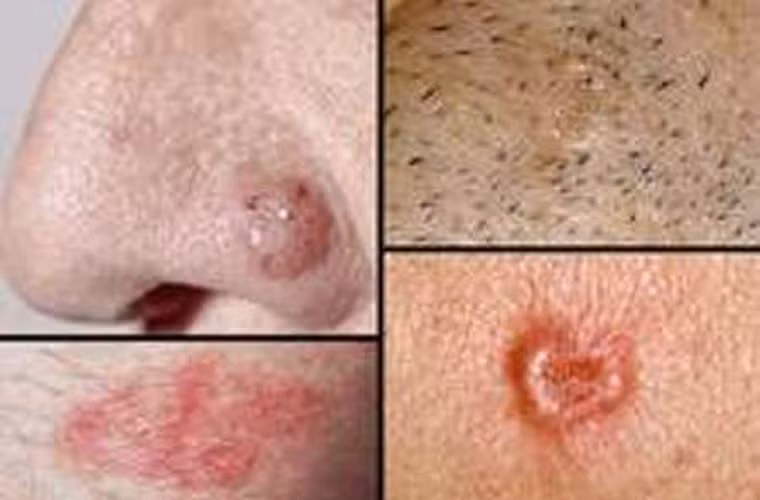 Một nghiên cứu khác được thực hiện bởi Bệnh viện Christie (Anh) cũng chỉ ra đối tượng trung lưu dễ mắc ung thư vú và ung thư da hơn người túng quẫn.