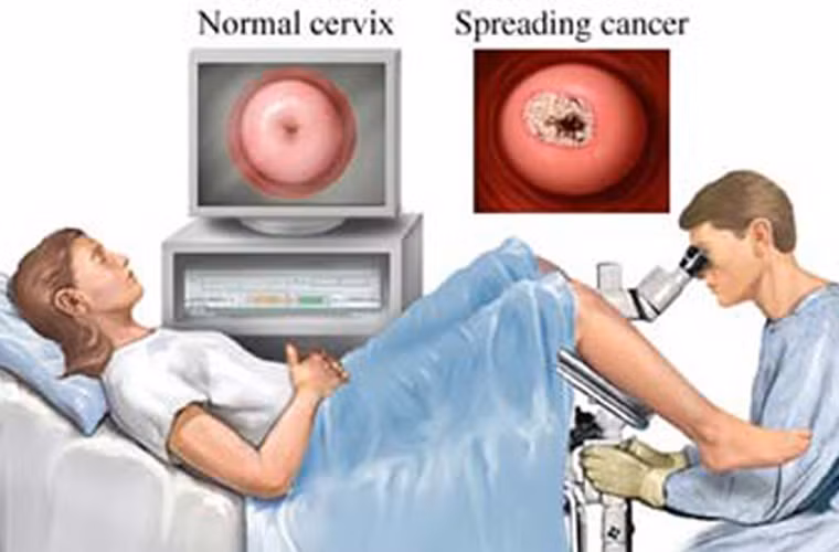 Ung thư cổ tử cung là một dạng ung thư chủ yếu do virus HPV gây nên. Việc thực hiện xét nghiệm Pap có ý nghĩa vô cùng quan trọng bởi phương pháp này cho phép bác sĩ dễ dàng phát hiện và loại bỏ các tế bào tiền ung thư.