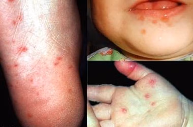 Bệnh tay, chân, miệng. Căn bệnh chủ yếu tấn công các bé dưới 5 tuổi song đôi khi cũng gặp ở người lớn. Bệnh nhân mắc tay, chân, miệng có dấu hiệu sốt, loét miệng và nổi mẩn trên da.