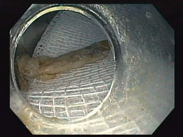 Gắp xương gà 2,5 cm cắm sâu vào thực quản nam bệnh nhân - Hình 2 Gap xuong ga 2,5 cm cam sau vao thuc quan nam benh nhan-Hinh-2
